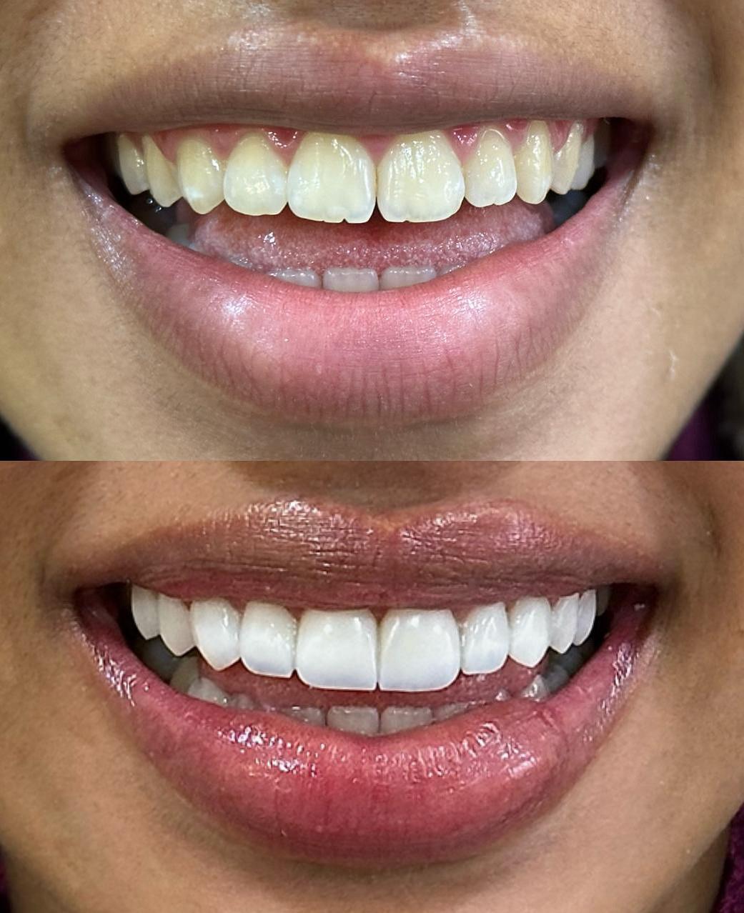 Tratamento com facetas em resina para sorriso harmônico